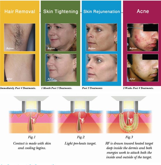 Elight (IPL+RF) + RF + laser 3 em 1 rejuvenescimento Multifunction da pele, máquina da remoção do cabelo do Ipl
