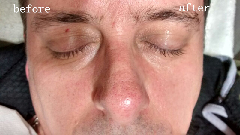 O olho focalizado alta intensidade do ultra-som de Hifu ensaca a remoção da testa do pescoço